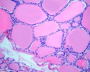 Normal healthy thyroid tissue showing large follicles and minimal ECM (dark purple follicular cells and parafollicular cells)