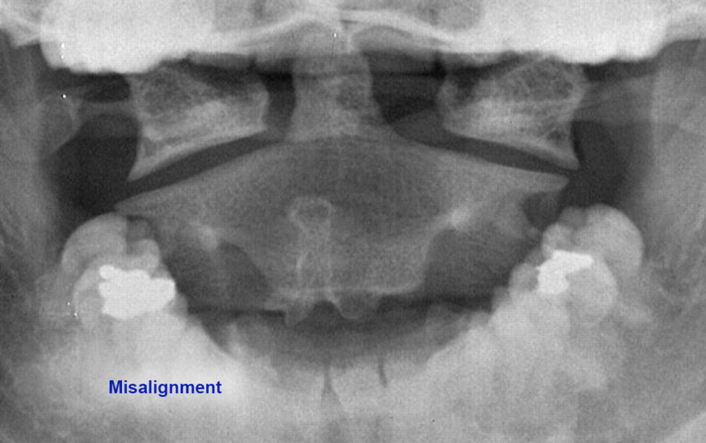In this view it's clear to see that the Atlas has misaligned severely to the left (wide gap between C1 and Odontoid of C2) It's a sure bet that this patient suffers from several Neurological symptoms