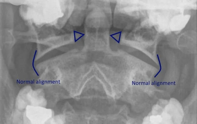 The triangles show the equal spacing between the Atlas and the Odontoid Process of the Axis (properly aligned)