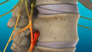 Spinal nerve pain